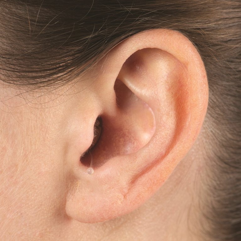 Close-up on a person's ear wearing an invisible-in-canal (IIC) hearing aid.